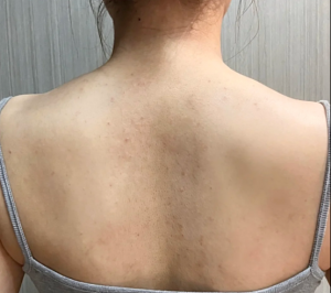 后背疙疙瘩瘩不敢穿露背装？这款Glysolid洋甘菊身体乳助你养出光滑软嫩肌
